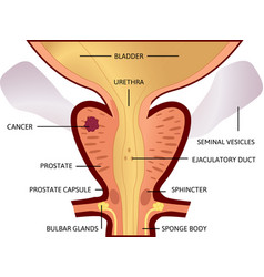 First Stage Prostate Cancer The Tumor Is Small