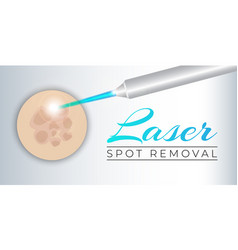 Laser Spot Removal Background