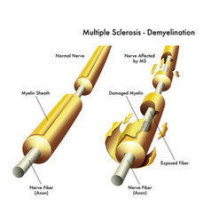 Multiple Sclerosis Nerve Damage