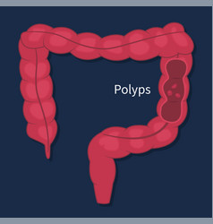 Flat Endoscopic Colon Cancer Polyps Checkup