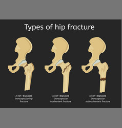 Types Of Hip Fracture