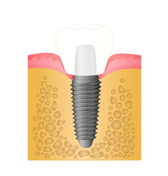 Dental Implant