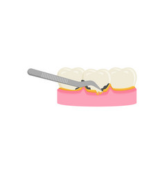 Teeth Scaling Dental Plaque Removal For Cleaning