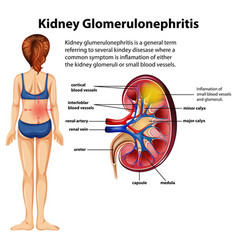 Medical Infographic Kidney Glomerulosclerosis