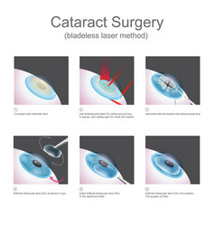 Cataract Surgery Blade-less Laser Method Use