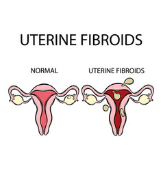 Uterine Fibroids Vs Normal Female Reproductive