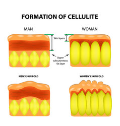 Cellulitis And Skin Aging In Men And Women