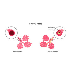 Bronchitis Lung Disease