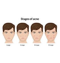 Stages Of Acne