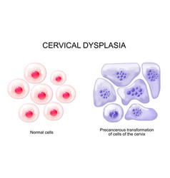 Cervical Dysplasia Cancer