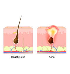 Acne Pimple Normal Hair Follicle And Clogged Pore