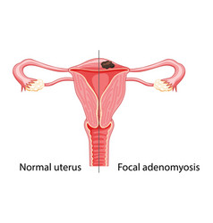 Adenomyosis Focal Human Anatomy Female