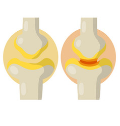 Arthritis Disease Of Joints Red Sore Spot