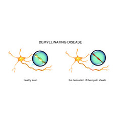 Demyelinating Diseases Neuron