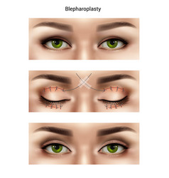 Blepharoplasty Suture Stitches Composition