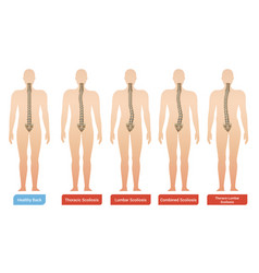 Spinal Curvature Infographic Set