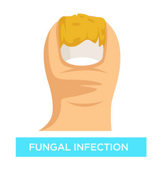 Fungal Infection Toenail Damage Suppuration Toe