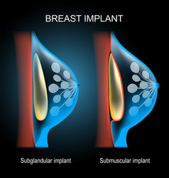 Breast Implant Placement Comparison X-ray Blue