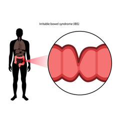 Irritable Bowel Syndrome