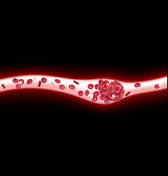 3d Of A Blood Clot In A Blood Vessel Showing