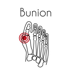 Bunion In Foot