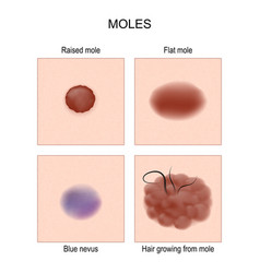 Nevus Or Mole Types Check