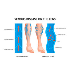 Venous Disease Of Legs Infographics Poster