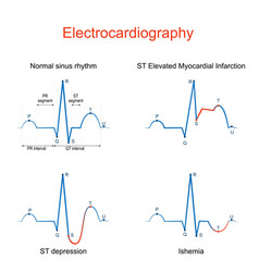 Electrocardiography Ecg Or Ekg