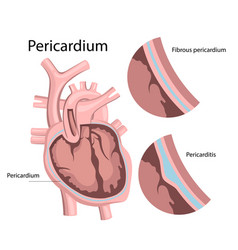 Inflammation Pericardium Heart Disease