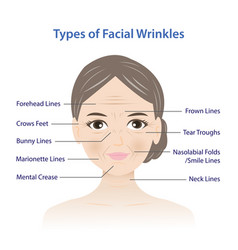 Types Of Facial Wrinkles