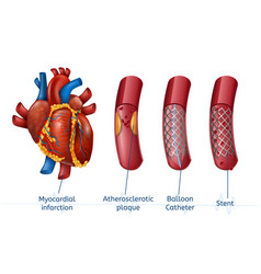 Myocardial Infarction 3d Realistic Stent In Heart