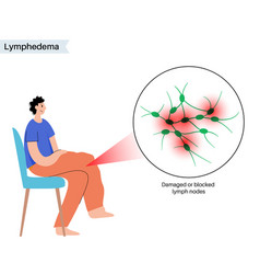 Lymphedema Leg Swelling