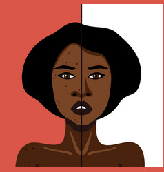 Image Of African American Woman Wit Acne On Skin