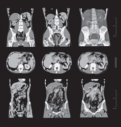 Set X-ray Of Human Abdomen With Pelvic Bone