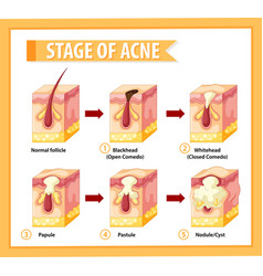 Stages Skin Acne Anatomy