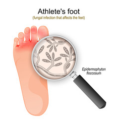 Athletes Foot Fungal Infection Of Epidermophyton