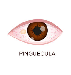 Pinguecula Conjunctival Degeneration Eye Disease