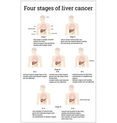 Four Stages Liver Cancer