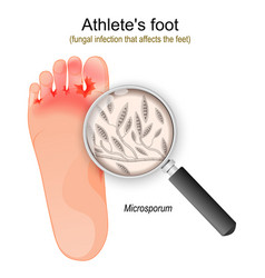 Athletes Foot Fungal Infection Of Microsporum