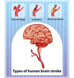 Types Of Human Brain Stroke