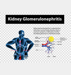 Diagram Showing Kidney Glomerulonephritis