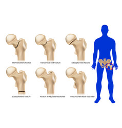 Femoral Neck Fracture Types Of Hip Fractures