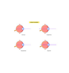 Refractive Errors Poster