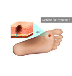 Diabetic Foot Syndrome Ulcer Destruction Of Deep