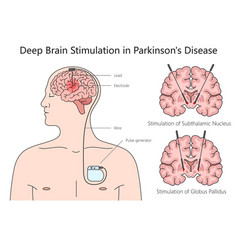 Deep Brain Stimulation Diagram Medical Science