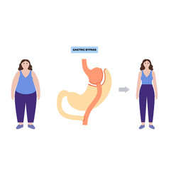 Gastric Bypass Surgery