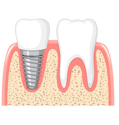 Heath Tooth And Dental Implant In Gum On White