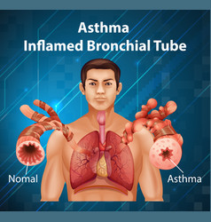 Human Anatomy Asthma Inflamed Bronchial Tube