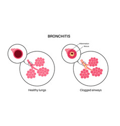 Bronchitis Lung Disease