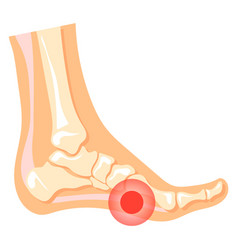 Leg Pain Red Spot In Human Foot Medical